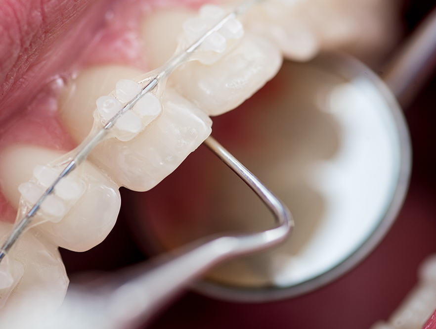 Traditional, Clear, and Lingual Braces - How is Each Used