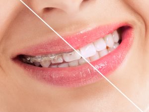 SureSmile braces before and after photos of woman with healthy smile