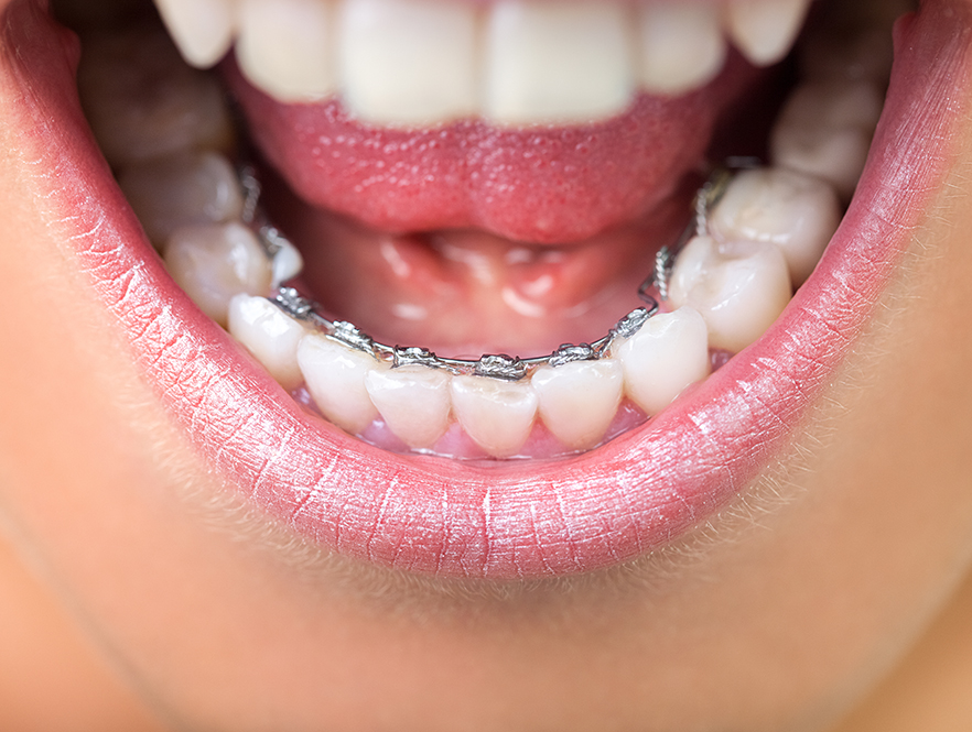 lingual braces work on the inside of the teeth