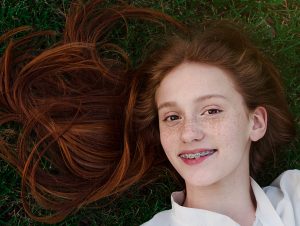 red haired girl has dual arch wire braces treatment